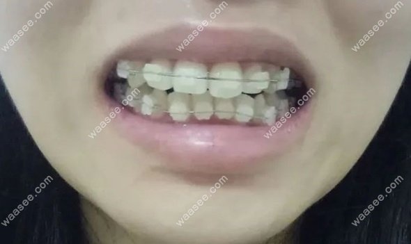 暨南雅皓英亚体育app下载官方正版矫正牙齿1年的结果 为什么我要做矫正?
