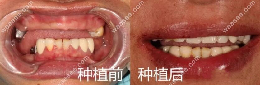 上半口种植牙前后对比图 张阿姨的脸上露出了难得的笑容