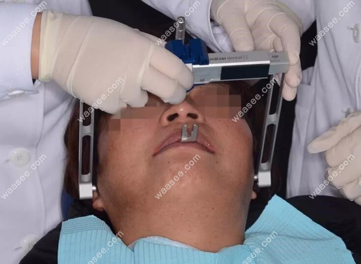 种牙前,用电子面弓为她测量 大口啃起了苹果